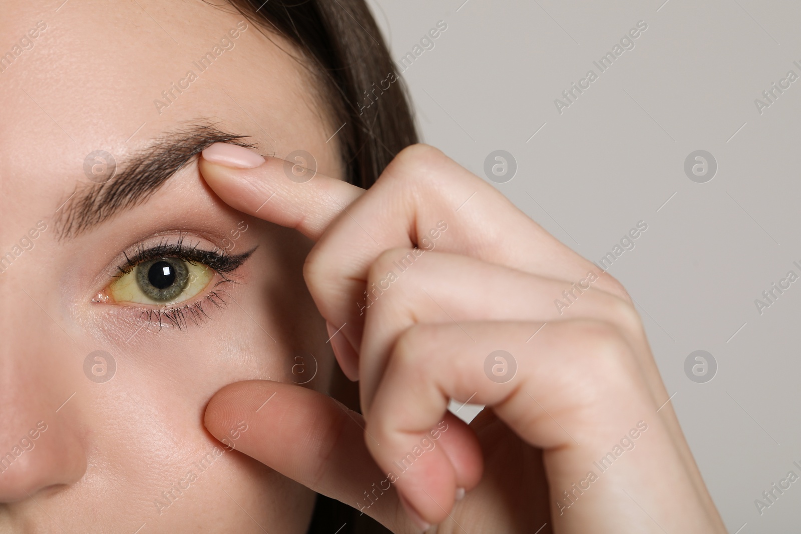 Photo of Woman checking her health condition on light grey background, closeup. Yellow eyes as symptom of hepatitis