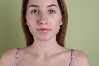 Photo of Young woman with acne problem on olive background