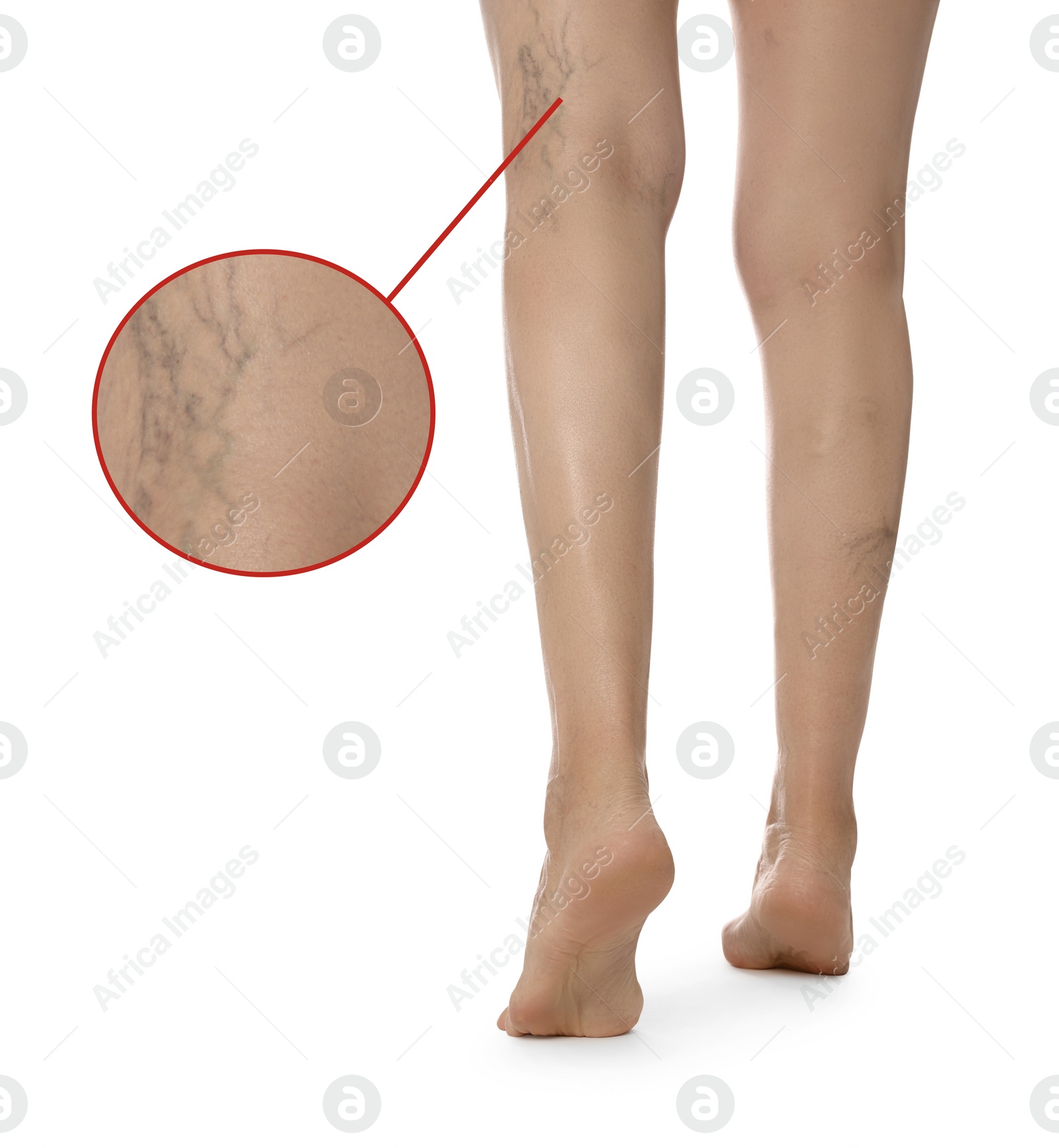 Image of Woman suffering from varicose veins on white background, closeup. Magnified skin surface showing affected area