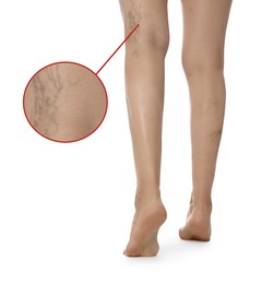 Woman suffering from varicose veins on white background, closeup. Magnified skin surface showing affected area