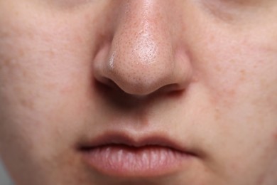 Photo of Closeup view of woman with comedones on her nose