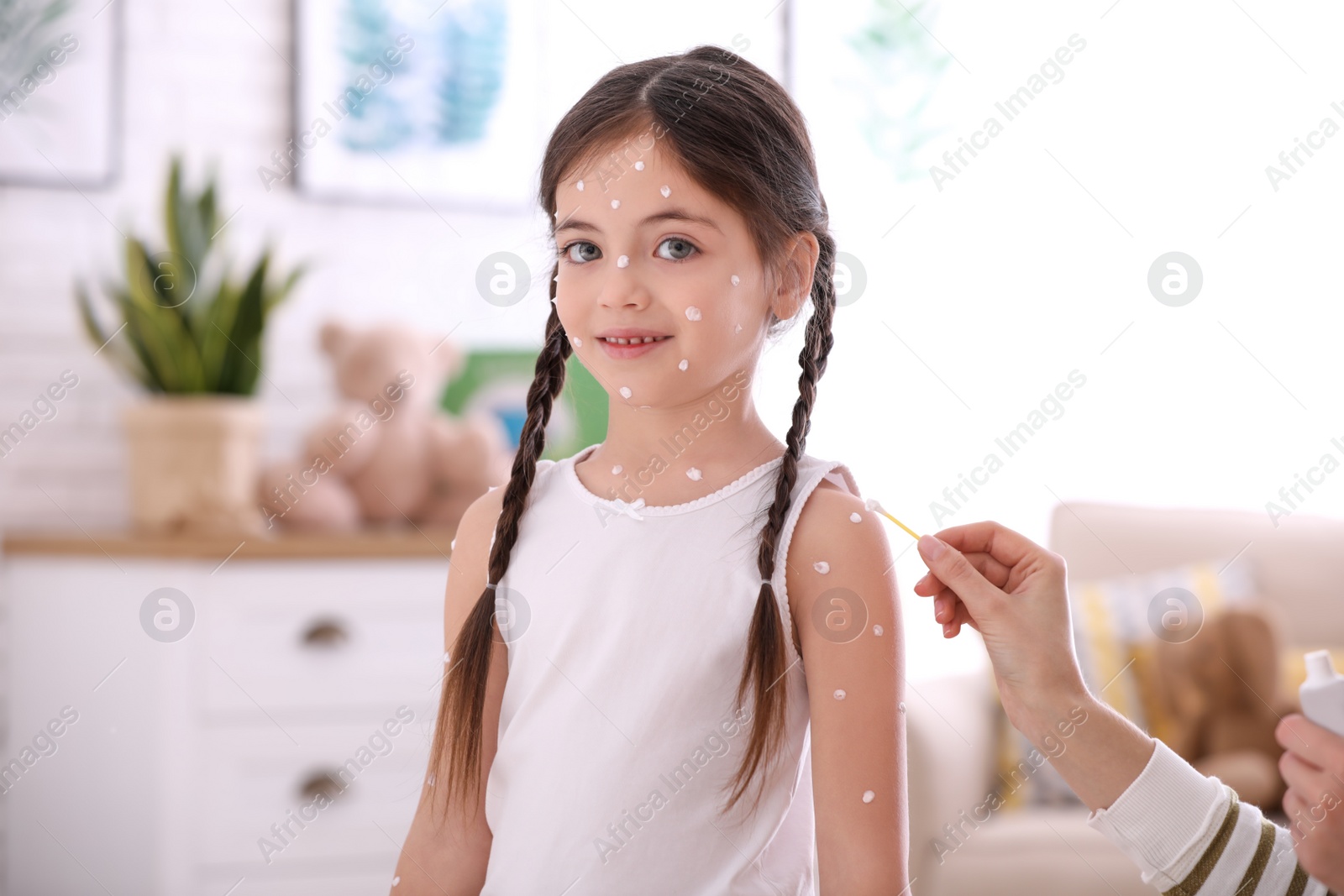 Photo of Mother applying cream onto skin of her daughter with chickenpox at home