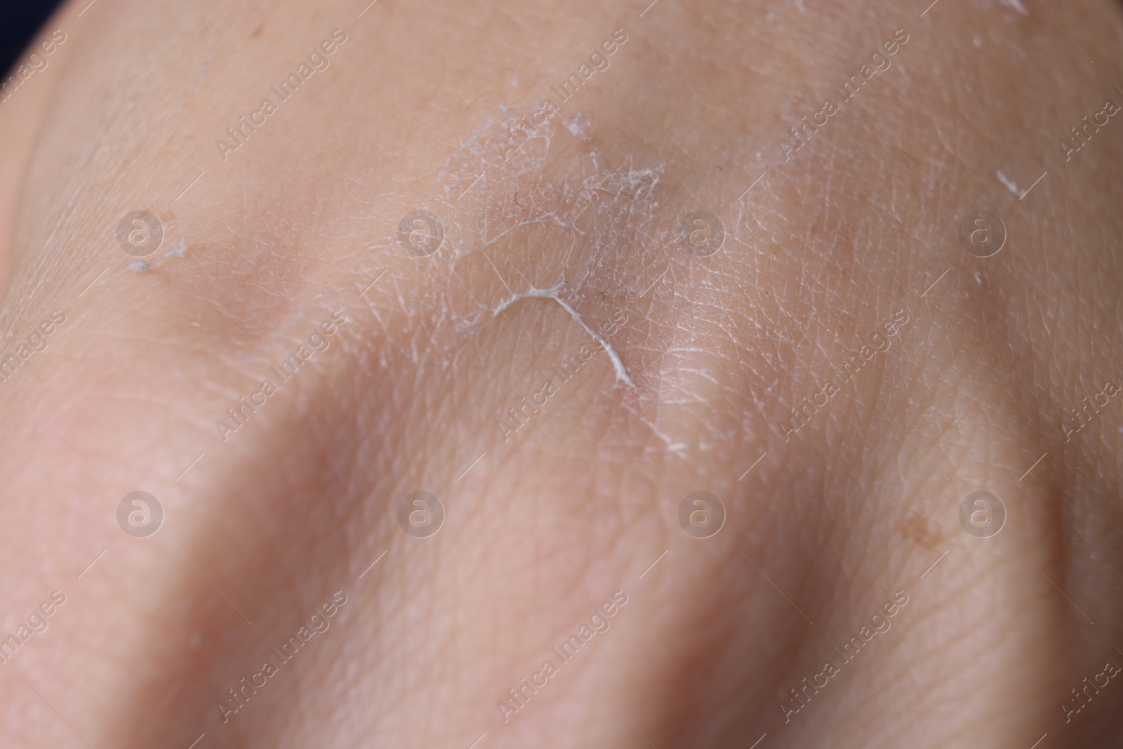 Photo of Woman with dry skin on hand, macro view