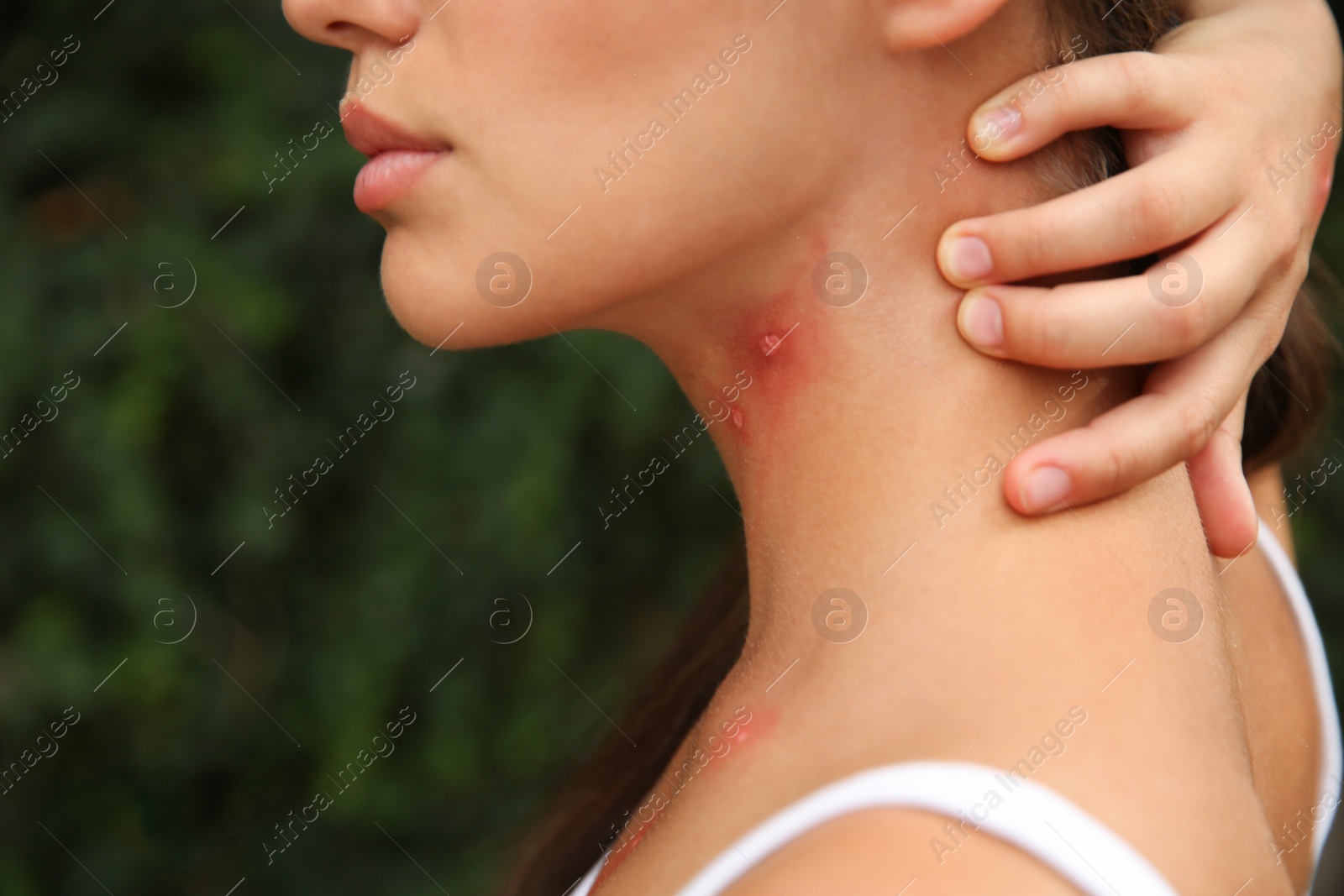 Photo of Woman scratching neck with insect bites in park, closeup