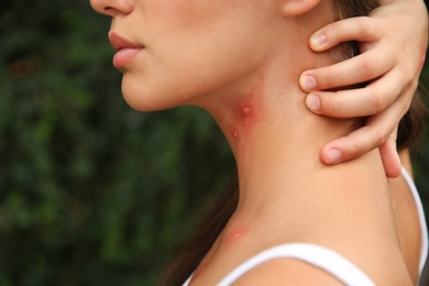 Woman scratching neck with insect bites in park, closeup