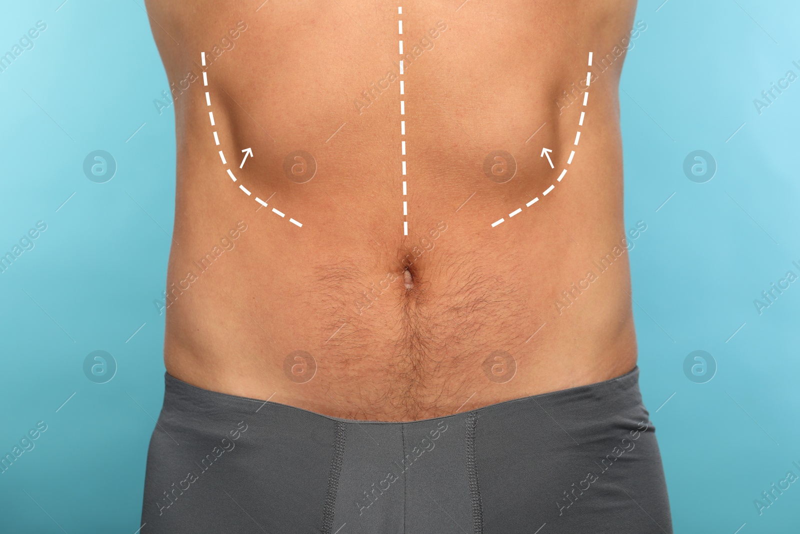 Image of Man with markings for cosmetic surgery on his abdomen against light blue background, closeup