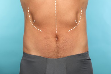 Image of Man with markings for cosmetic surgery on his abdomen against light blue background, closeup