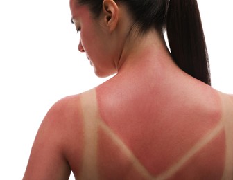 Photo of Woman with sunburned skin on white background, closeup