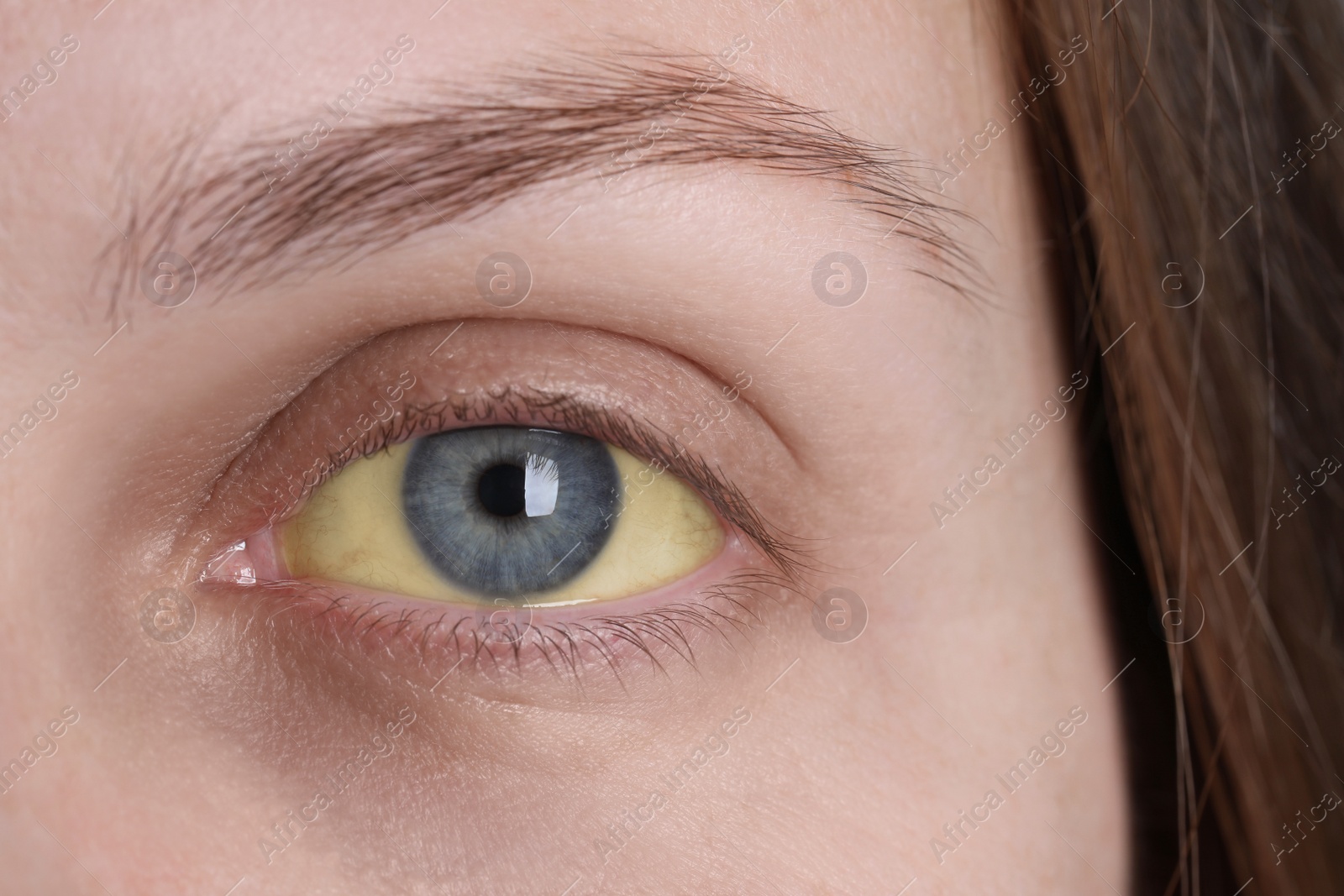 Photo of Woman with yellow eyes, closeup view. Symptom of hepatitis