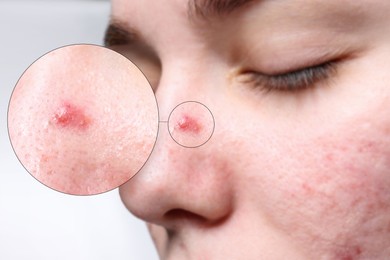 Image of Dermatology. Woman with skin problem on light background, closeup. Zoomed area showing acne
