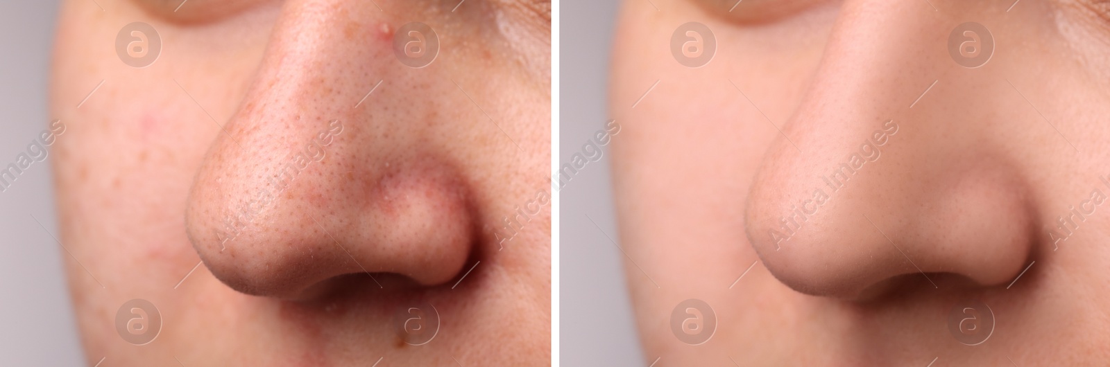 Image of Photos of woman before and after acne treatment, closeup. Collage showing affected and healthy skin