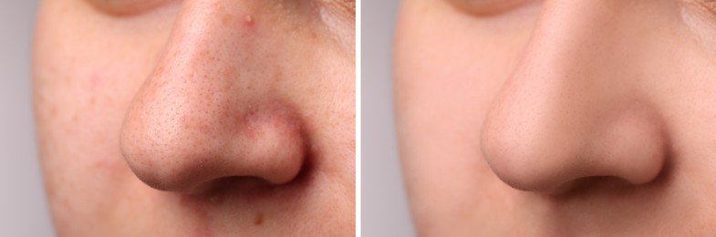 Photos of woman before and after acne treatment, closeup. Collage showing affected and healthy skin