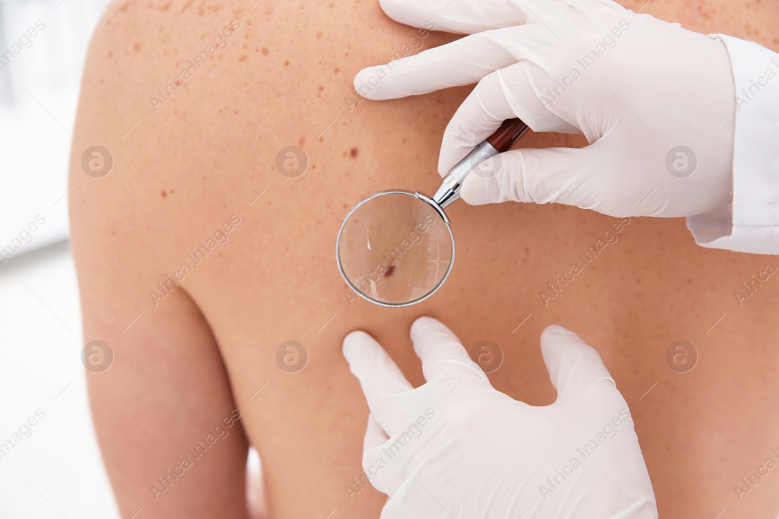 Photo of Dermatologist examining patient's birthmark with magnifying glass in clinic, closeup