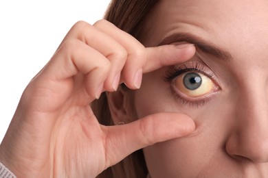 Woman checking her health condition on white background, closeup. Yellow eyes as symptom of problems with liver