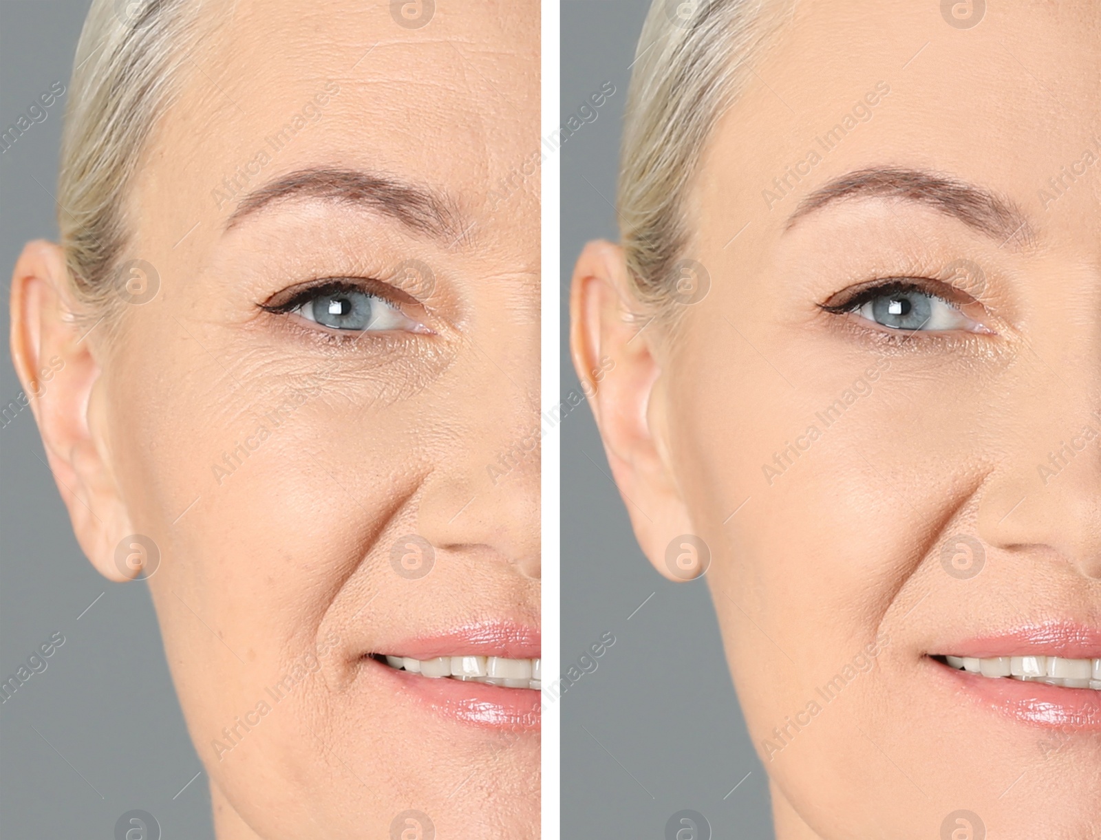 Image of Collage with photos of mature woman before and after biorevitalization procedure on grey background, closeup 