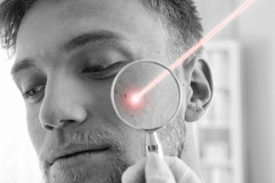 Image of Laser mole removal. Doctor looking at patient's skin through magnifying glass during procedure in clinic, closeup. Black and white effect
