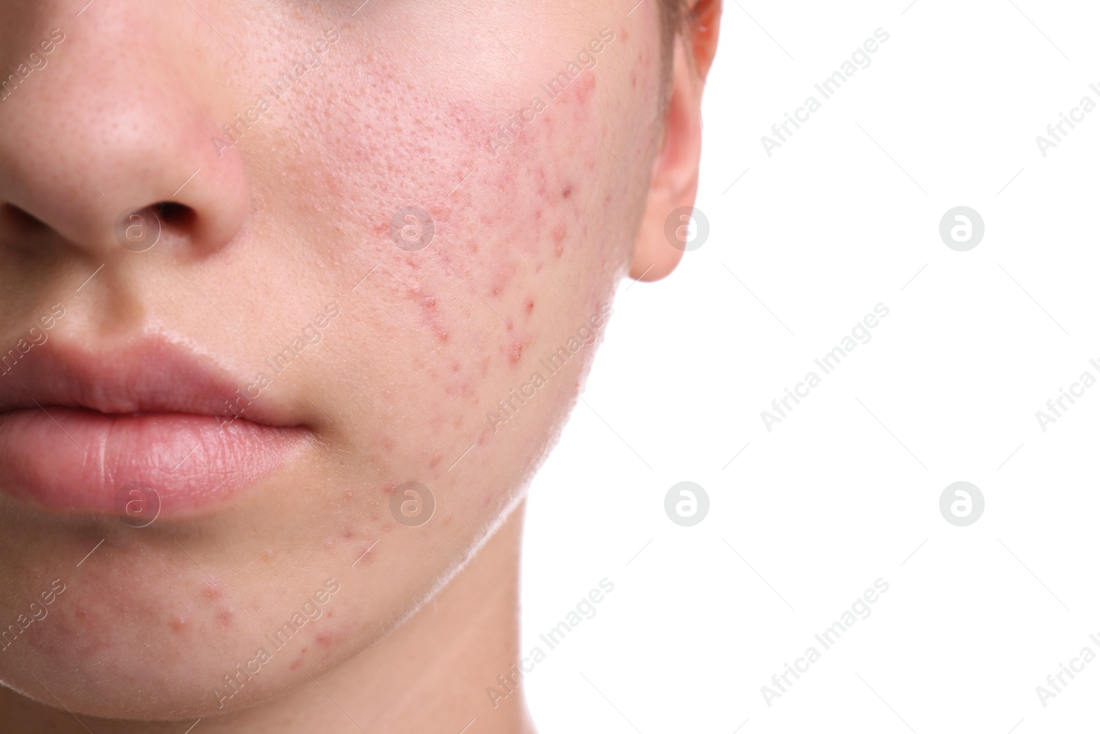 Photo of Teenage girl with acne problem on white background, closeup