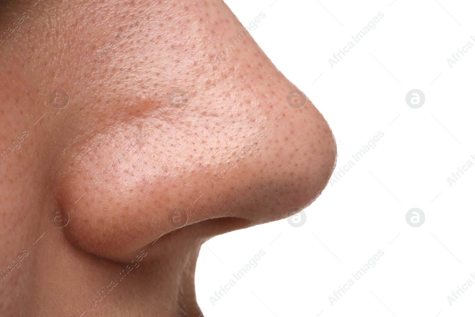 Photo of Young woman with acne problem on white background, closeup view of nose