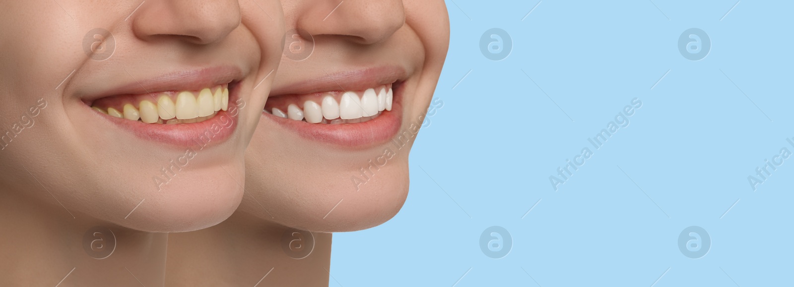 Image of Collage with photos of woman before and after tooth whitening on light blue background, closeup. Banner design with space for text