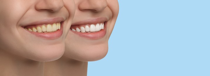 Collage with photos of woman before and after tooth whitening on light blue background, closeup. Banner design with space for text