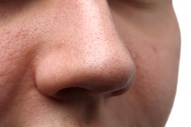 Photo of Young woman with acne problem on white background, closeup view of nose