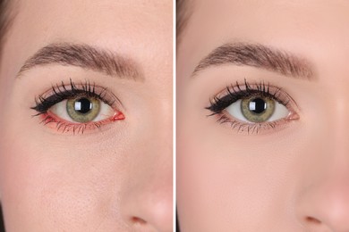Image of Collage with photos of woman before and after conjunctivitis treatment, closeup of eye