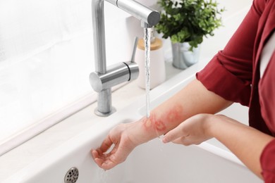 Woman putting hand with burns under cold running water indoors, closeup