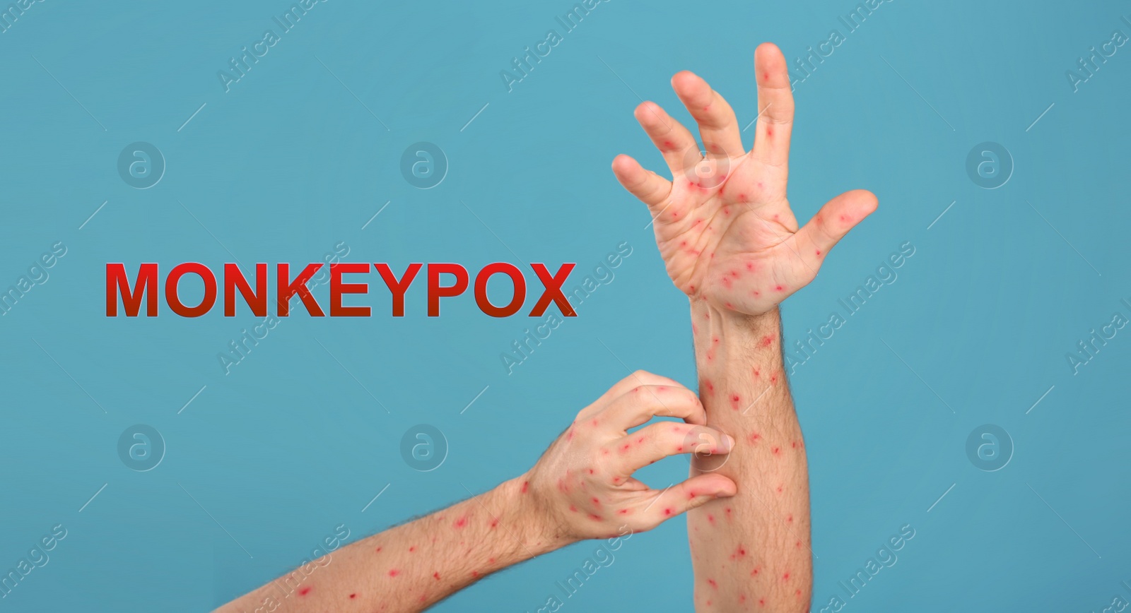 Image of Man with rash suffering from monkeypox virus on light blue background, closeup