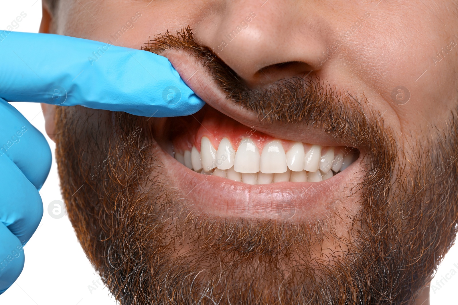 Image of Doctor examining man's inflamed gum on white background, closeup