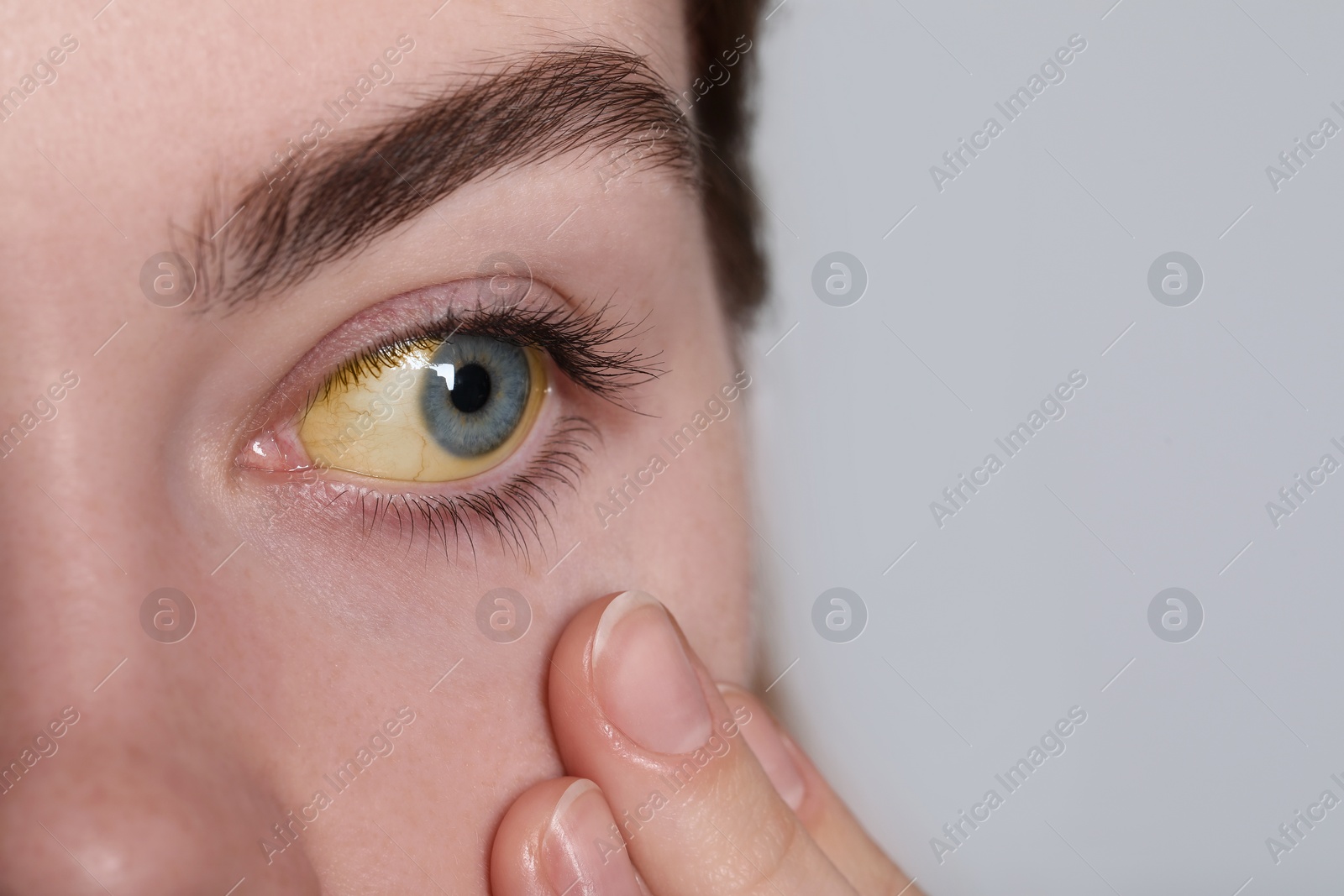 Photo of Woman with yellow eyes on white background, closeup. Symptom of hepatitis