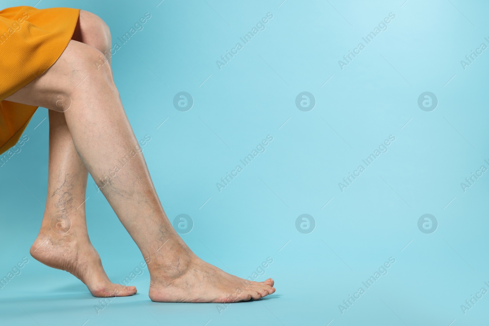 Photo of Closeup view of woman with varicose veins on light blue background. Space for text