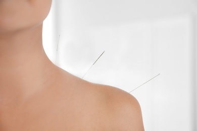 Young woman undergoing acupuncture treatment in salon, closeup