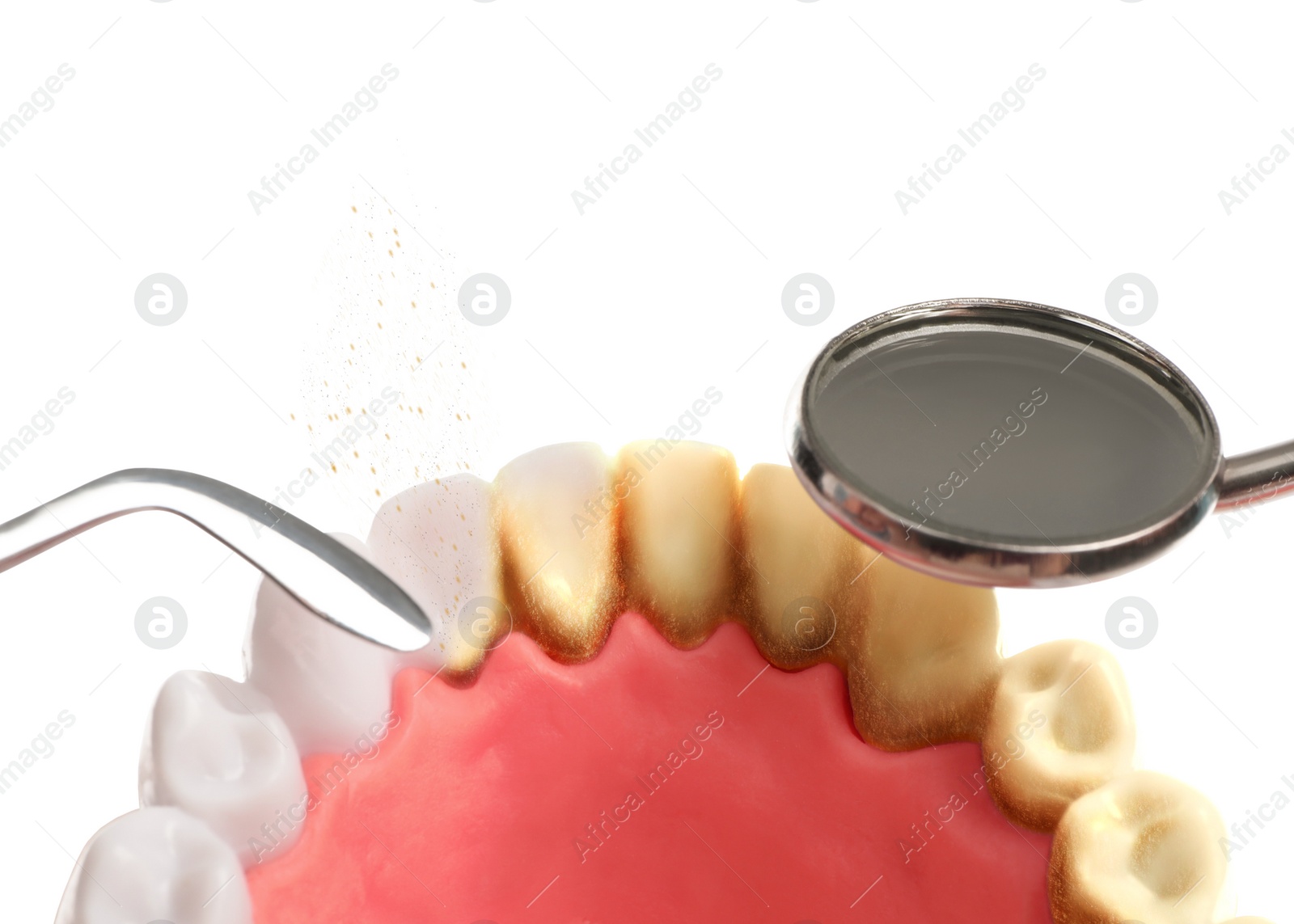 Image of Examining teeth with calculus on white background