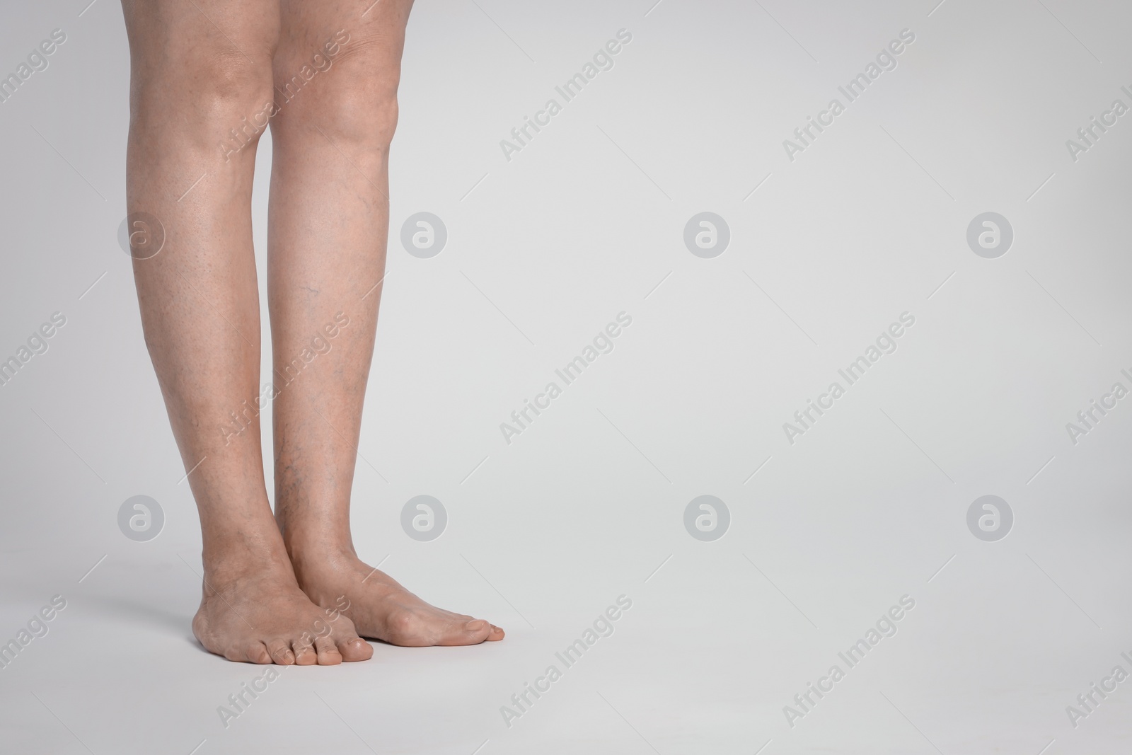 Photo of Closeup view of woman with varicose veins on light background. Space for text