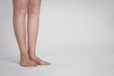 Closeup view of woman with varicose veins on light background. Space for text