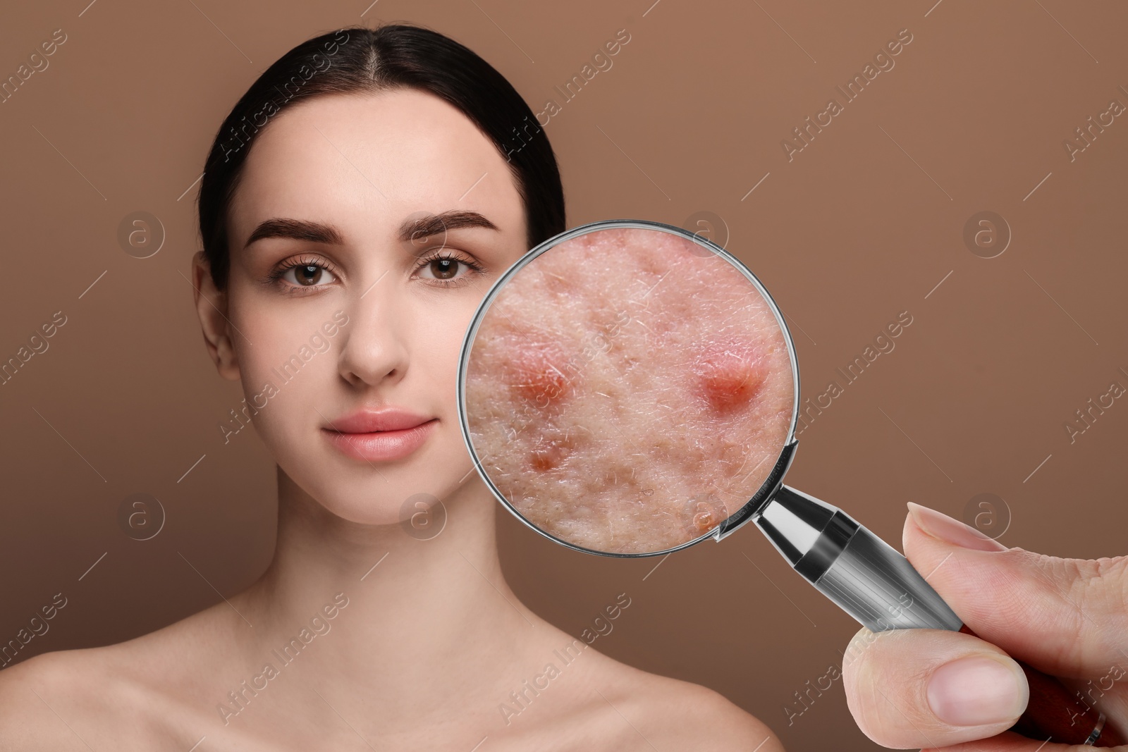 Image of Dermatologist looking at woman's face with magnifying glass on brown background, closeup. Zoomed view on acne