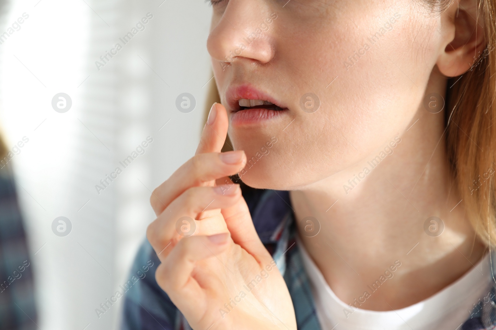Photo of Woman suffering from herpes against light background, closeup