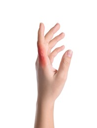 Woman with burn of her hand on white background, closeup