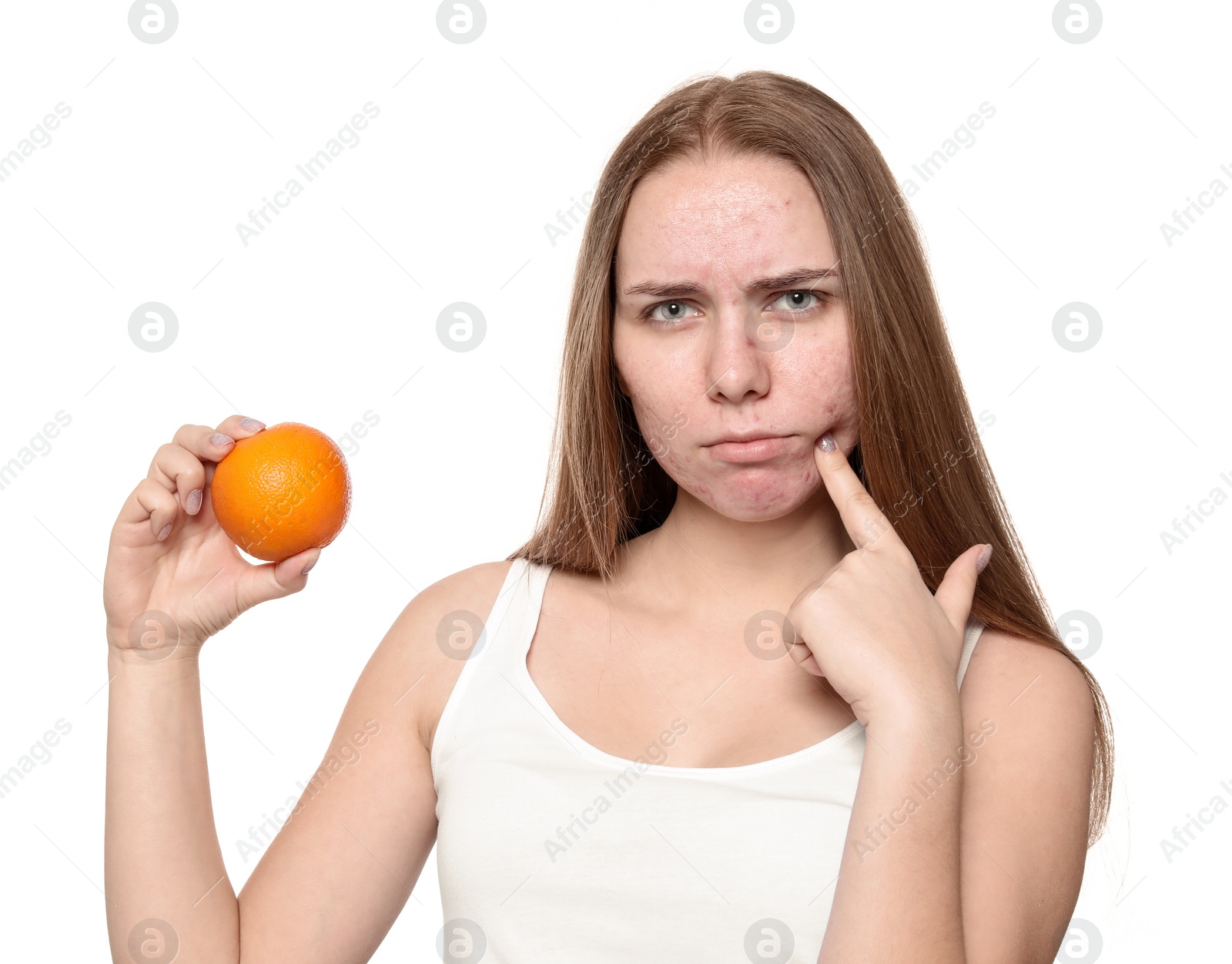 Photo of Young woman with acne problem holding orange on white background. Skin allergy