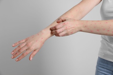 Woman with rash suffering from monkeypox virus on light grey background, closeup