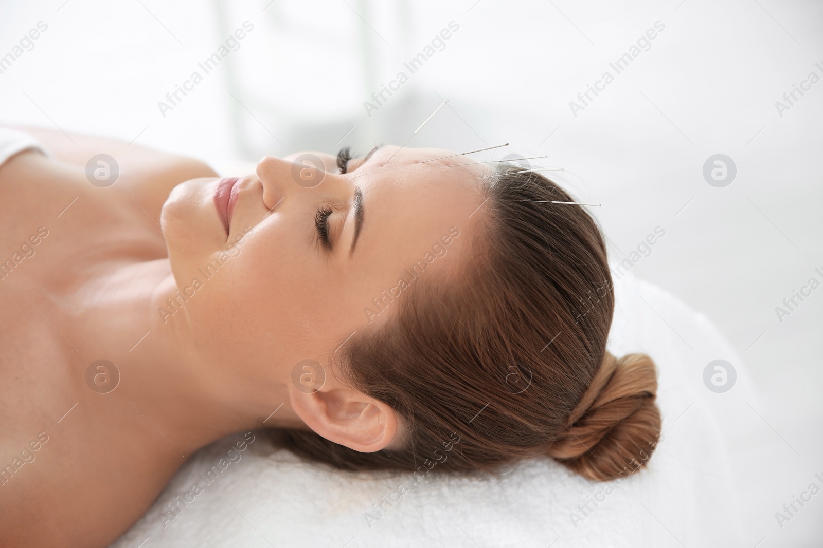 Photo of Young woman undergoing acupuncture treatment in salon