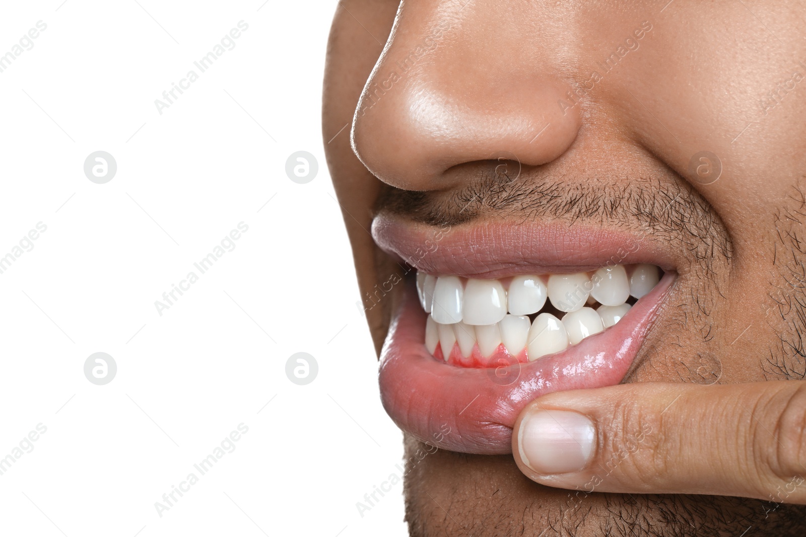 Image of Man showing inflamed gum on white background, closeup