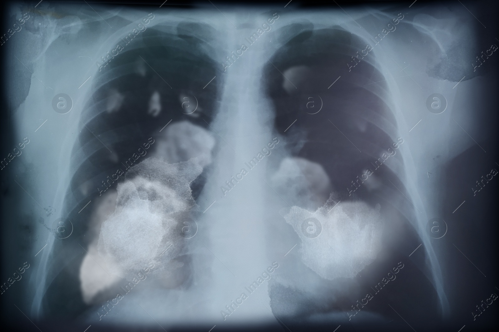 Illustration of X-ray image of patient with lung cancer. Illustration