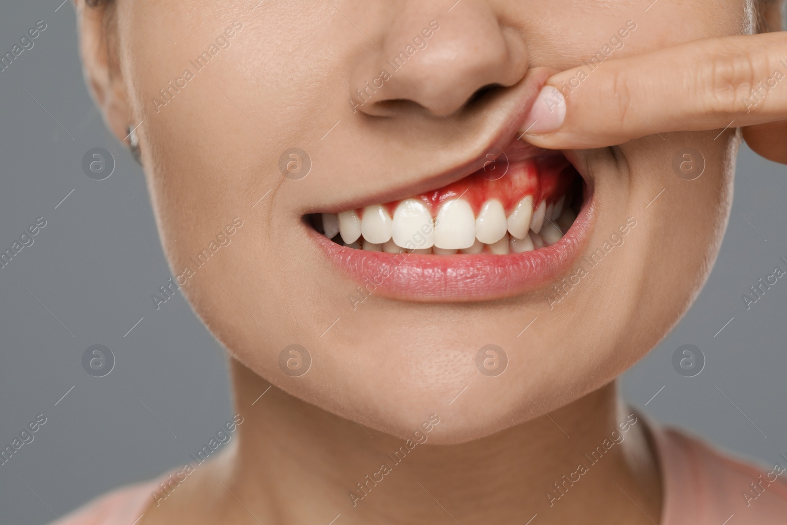 Image of Woman showing inflamed gum on grey background, closeup