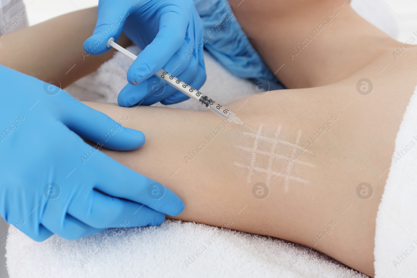 Photo of Cosmetologist injecting young woman's armpit, closeup. Treatment of hyperhidrosis