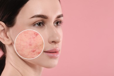 Image of Woman before and after cosmetology procedure on pink background, space for text. Zoomed area showing problem skin