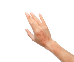 Image of Woman showing hand with dry skin on white background, closeup