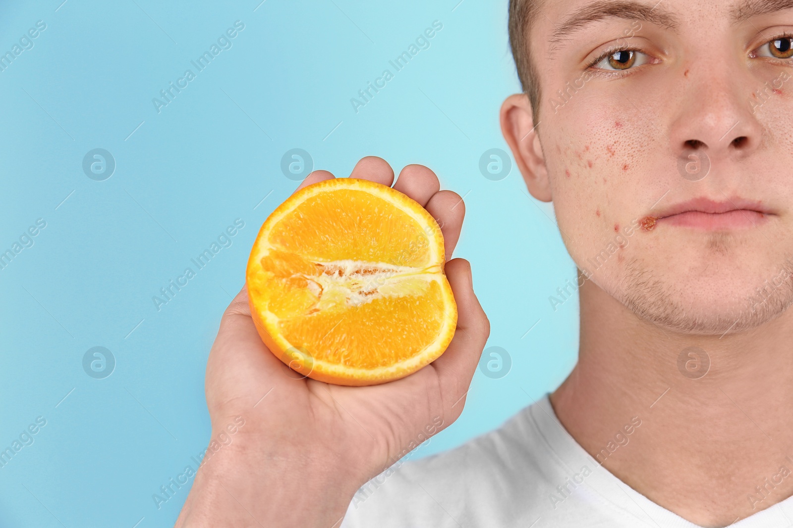 Photo of Young man with acne problem holding orange on color background. Skin allergy
