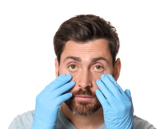 Doctor checking man with yellow eyes on white background. Symptom of hepatitis