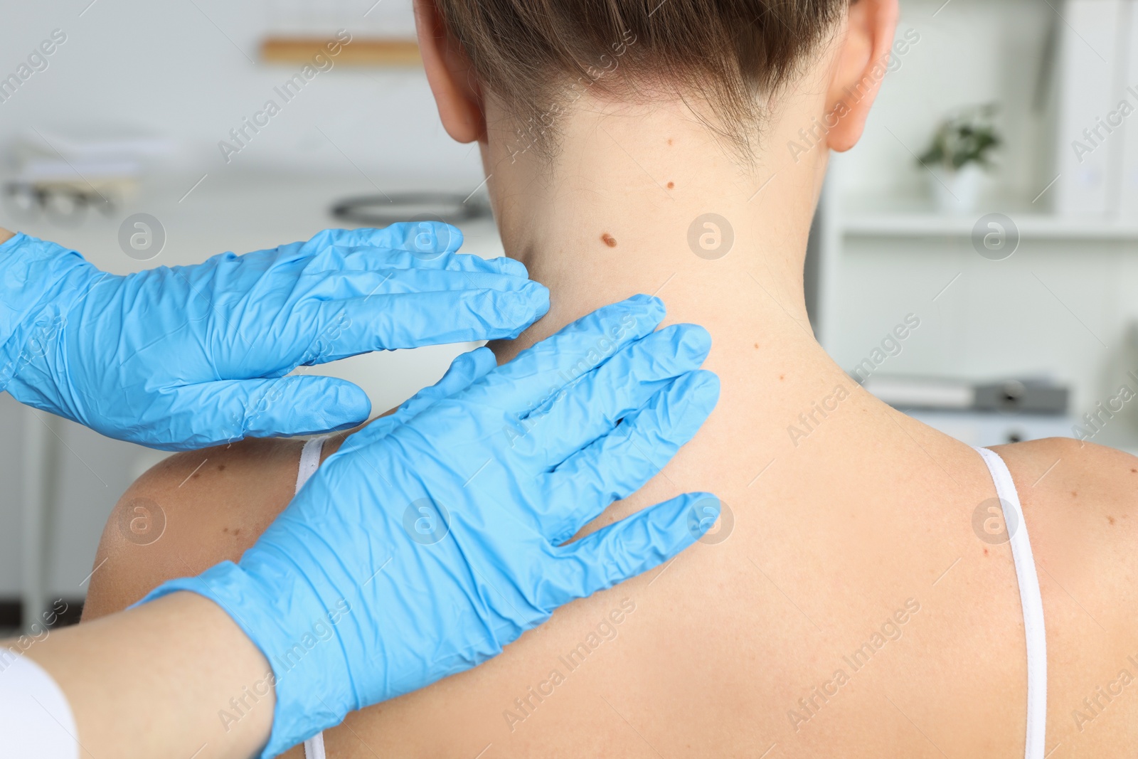 Photo of Dermatologist examining patient's birthmark in clinic, closeup